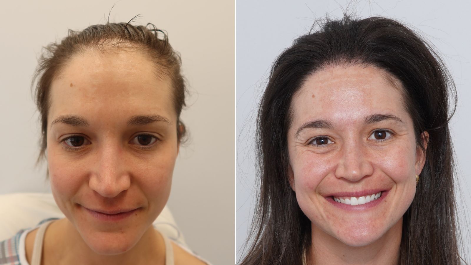 Hannah P., Denver, Hybrid FUE: Front, before and at 23 months.