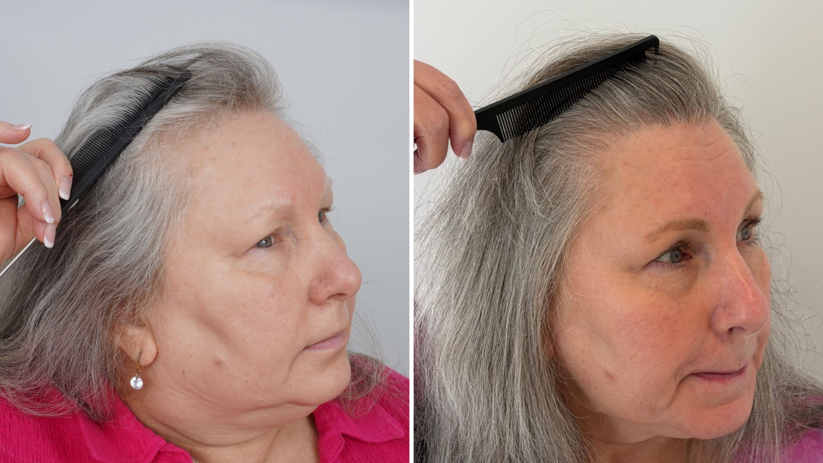 Diane W., Bellevue, 2,534 Hybrid FUE grafts: before, and 18 months after her hair transplant