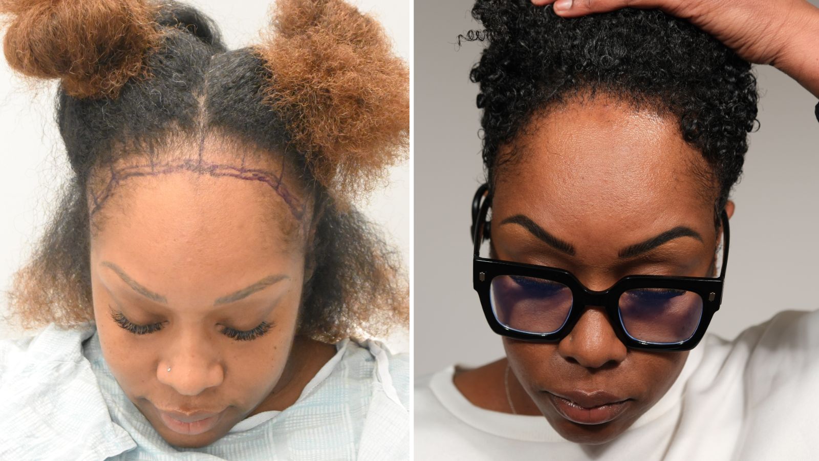 Tasha B., Dallas: before, and 12 months after her hair transplant