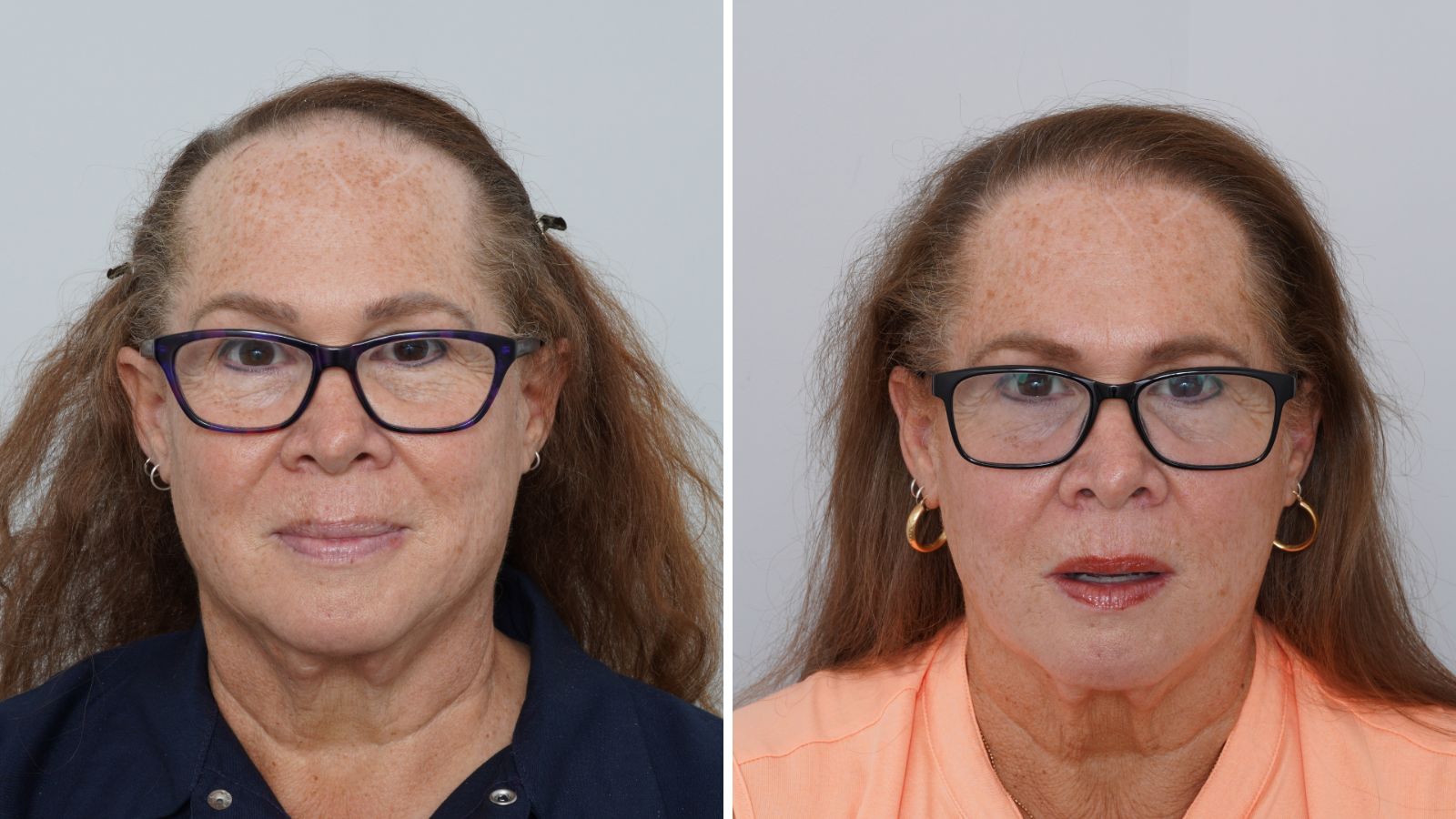 Rosa M., Denver, Linear FUT: before, and 13 months after her hair transplant