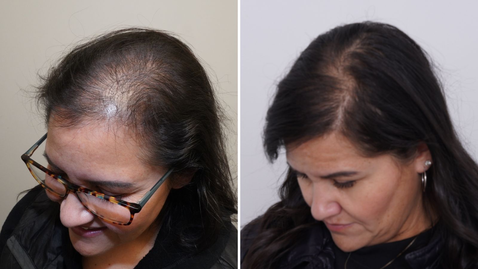 Gloria S., Denver, Linear FUT: before, and 12 months after her hair transplant