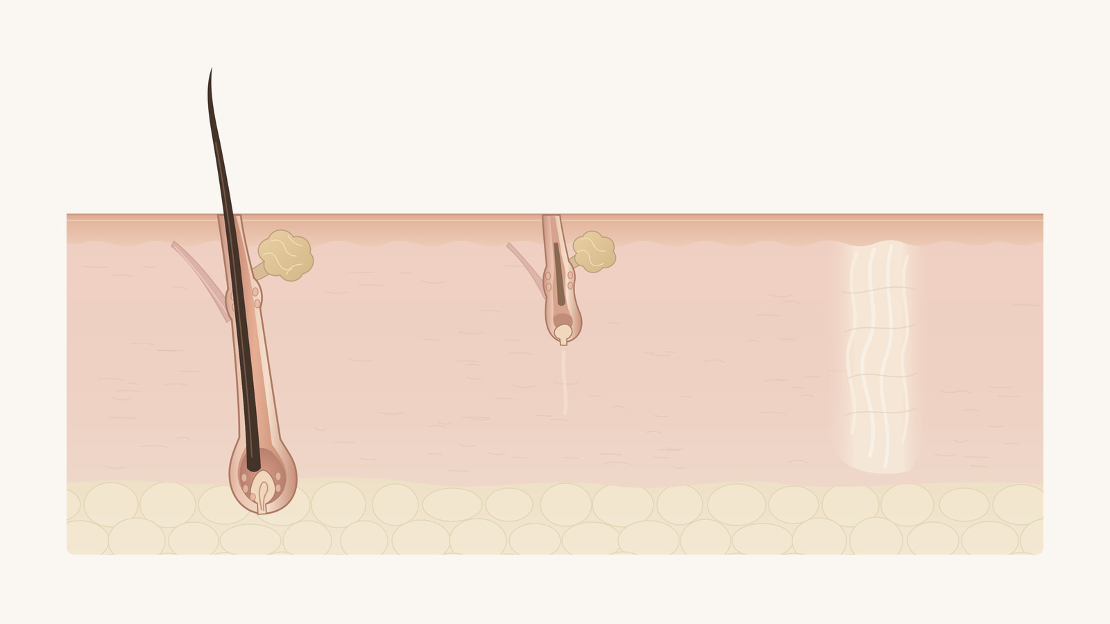Scalp cross-section with a growing hair at left, a small retained follicle at center and a fibrous site at right.