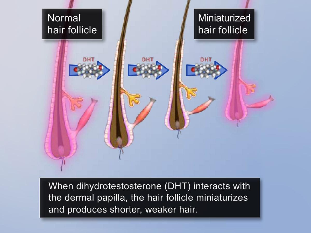 Follicle miniaturization diagram: under DHT, a normal hair follicle shrinks step by step into a miniaturized hair follicle. The text in the image reads: when dihydrotestosterone (DHT) interacts with the dermal papilla, the hair follicle miniaturizes and produces shorter, weaker hair.