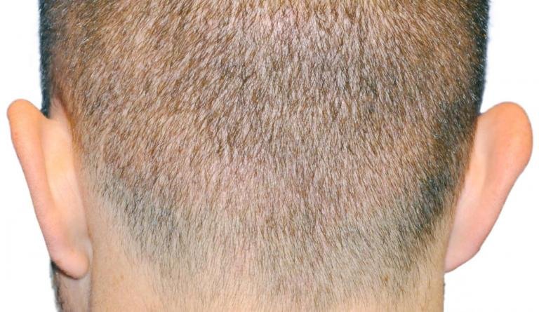The back of a man's head with the hair clipped short, showing a healed FUE donor area with no linear scar
