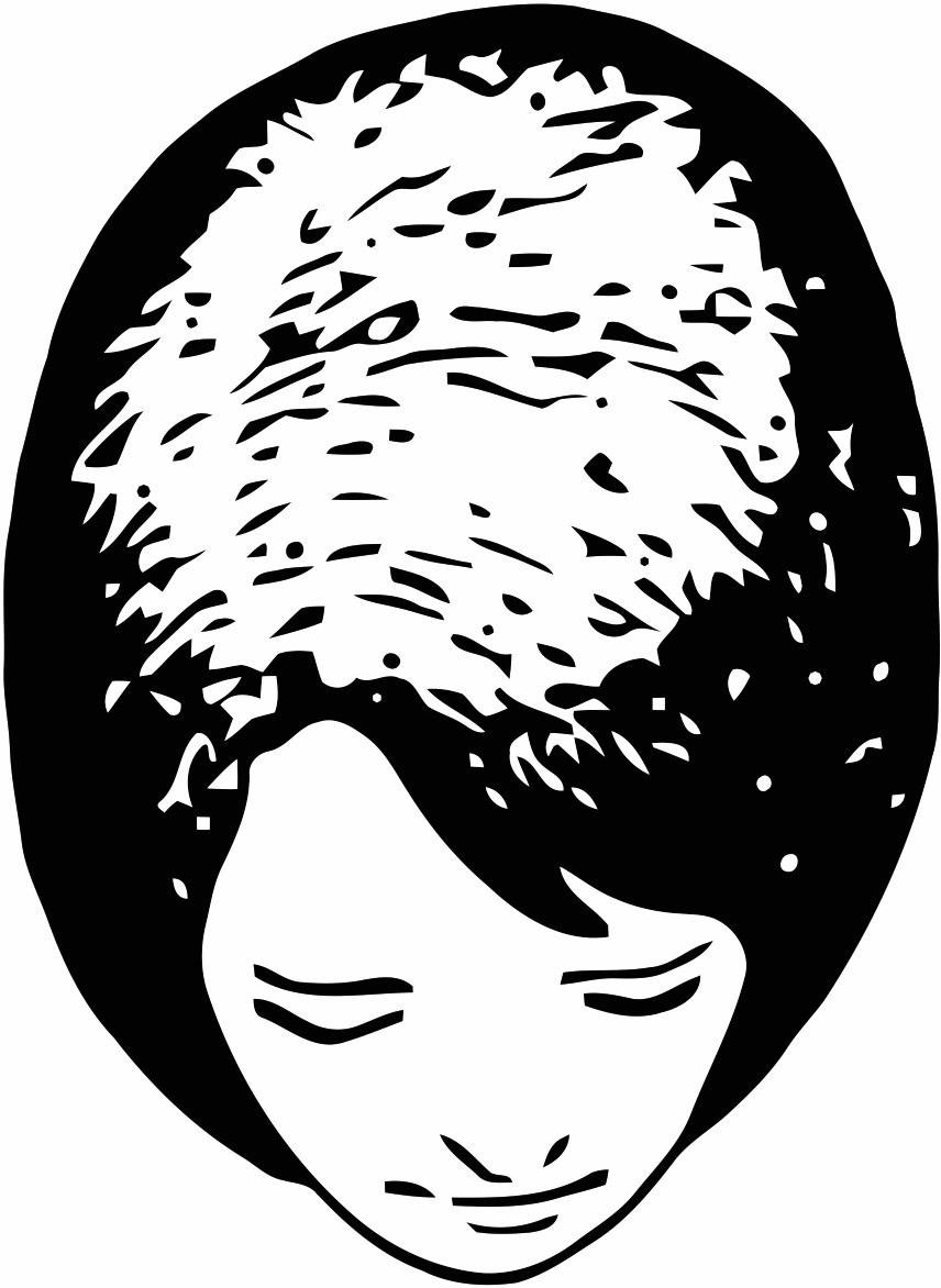 Hair loss scale: Ludwig scale grade 1, an illustration of a woman's head seen from above with thinning across the top of the scalp, many hairs remaining, and the front hairline intact