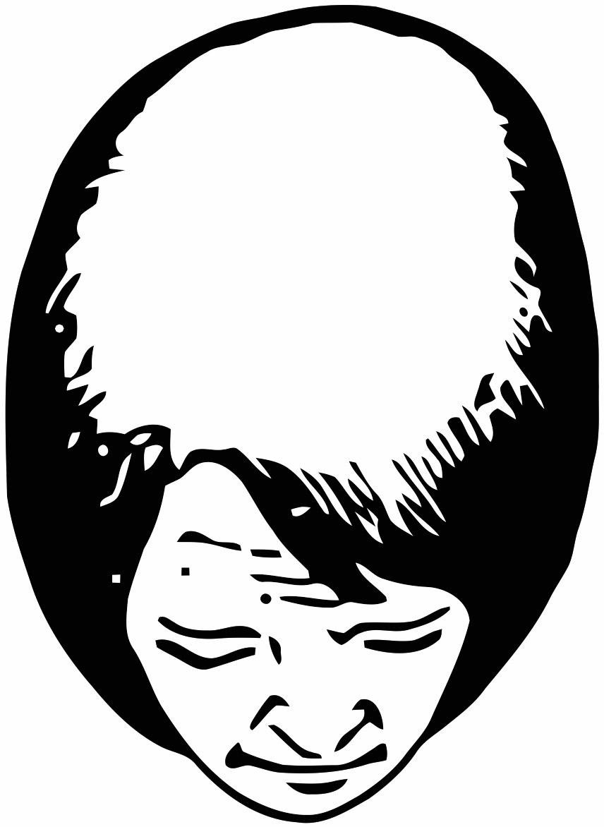Hair loss scale: Ludwig scale grade 3, an illustration of a woman's head seen from above with nearly full hair loss across the top of the scalp and the front hairline intact