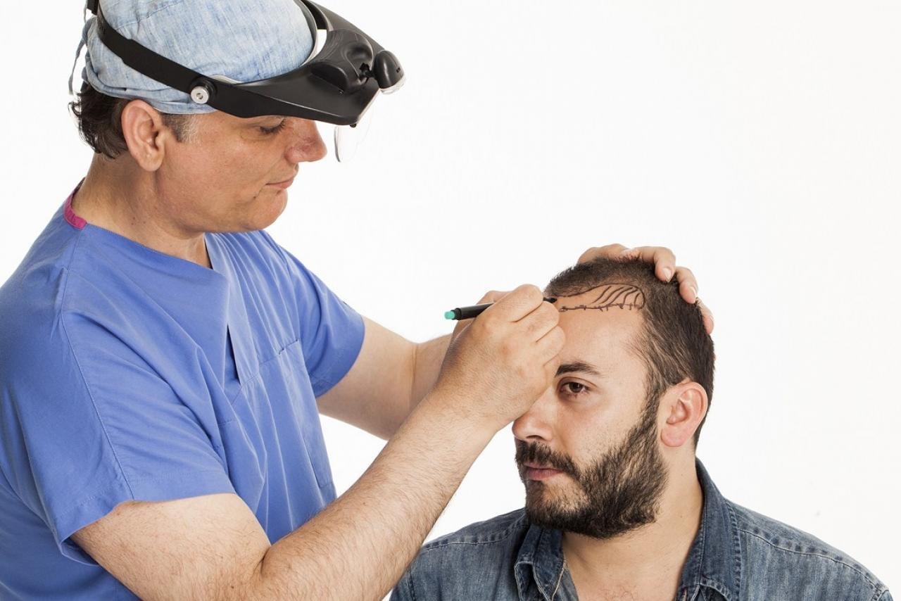 Physician drawing a new hairline for a hair transplant patient, marking the planned hairline on his forehead with a pen