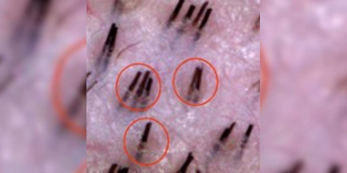 Magnified view of the scalp with circled follicular units showing healthy hairs growing after low-level laser therapy