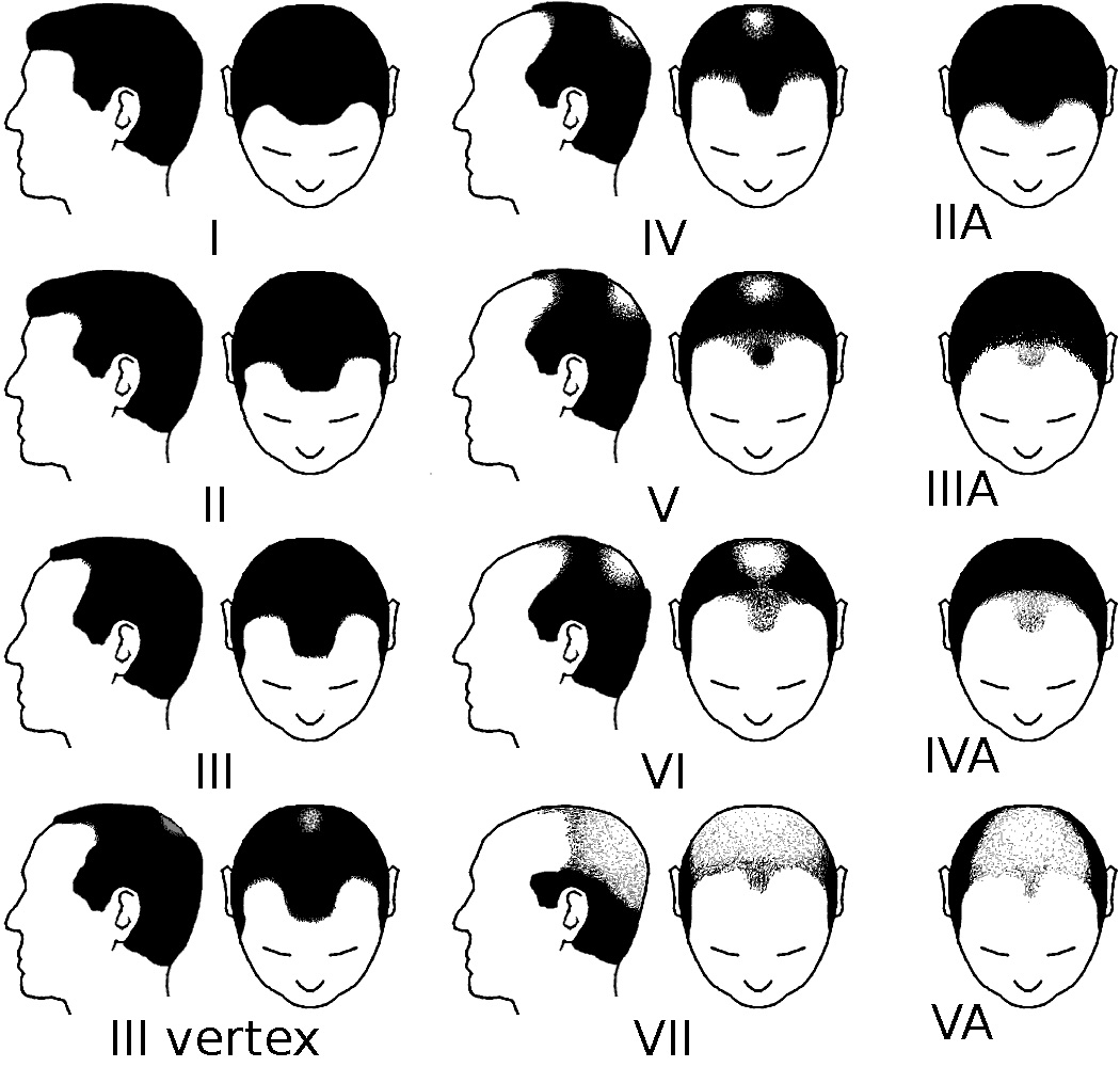 The Norwood scale chart, stages I to VII with the A variants, shown in side and top views