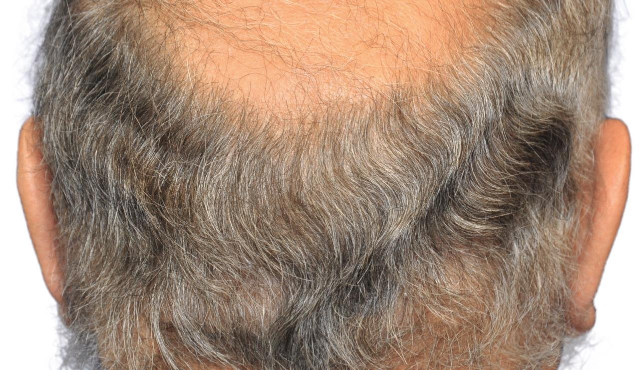 Rear of a patient's head, showing the fringe of gray hair at the back and sides, the donor area for an FUT hair transplant, and thinning on the crown