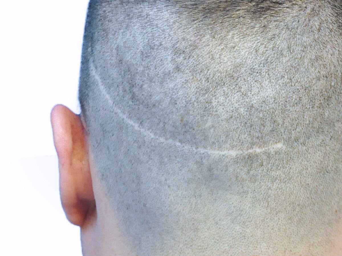 Close-up of the back of a man's closely clipped head, showing a thin, pale linear strip scar that curves across the donor area from above the ear