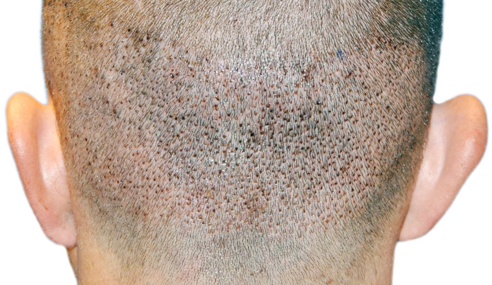 Donor area the day after an Advanced FUE™ hair transplant