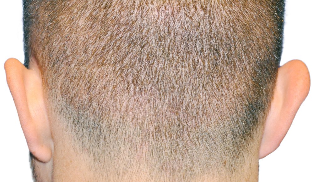 Donor area 1 week after Advanced FUE™