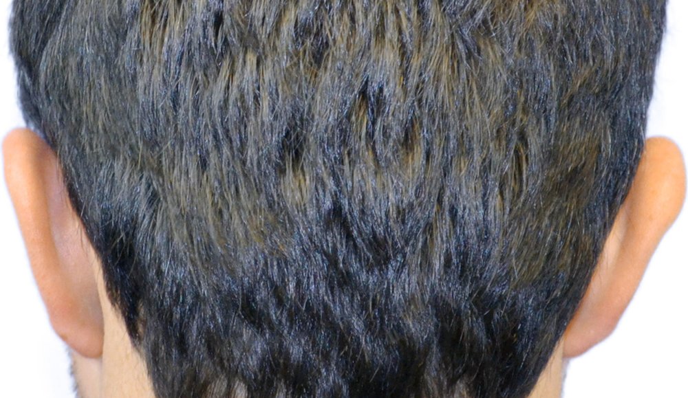 Donor area 8 months after Advanced FUE™