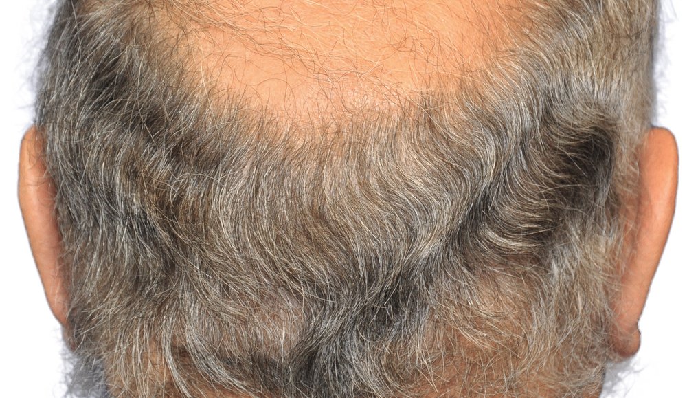 Donor area 8 months after FUT