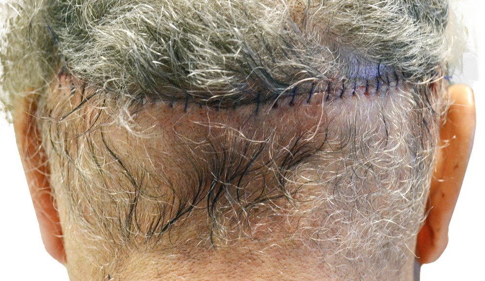 Donor area the day after an FUT strip procedure